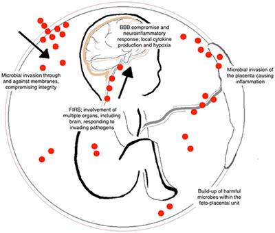 Perinatal Brain Injury As a Consequence of Preterm Birth and Intrauterine Inflammation: Designing Targeted Stem Cell Therapies